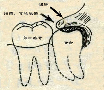 智齒發炎怎麽辦