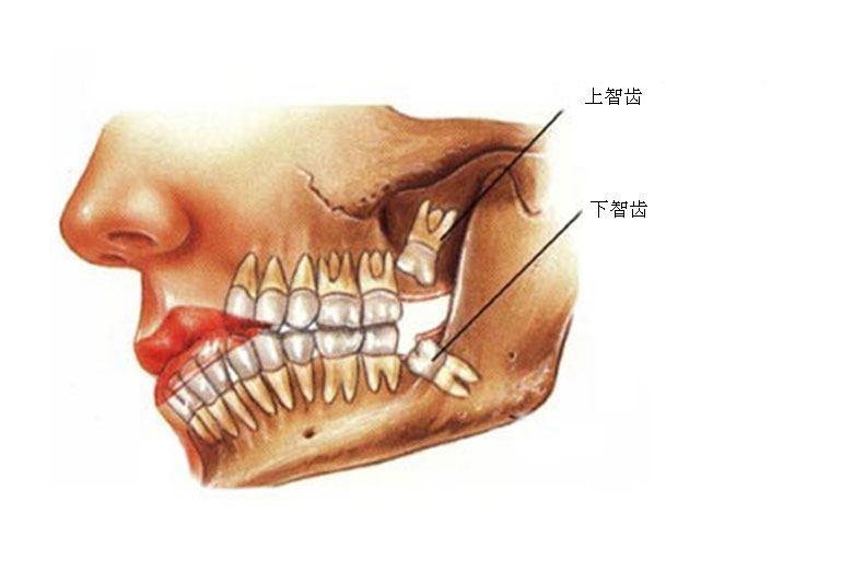 智齒一(yī)定要拔嗎(ma)