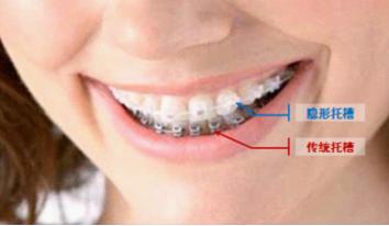 武漢口腔正畸方法