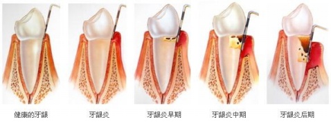 愛齒爾口腔治療牙龈炎