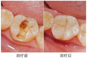 愛齒爾治療兒童蟲牙