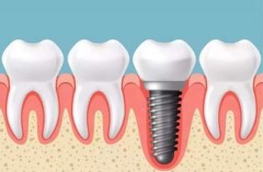單顆牙缺失種植牙修複效果怎麽樣？