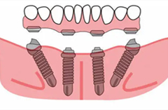 老年人全口牙缺失怎麽辦？