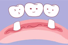牙缺失，鑲牙還是種植牙？