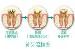 補牙三步曲，補出完整好牙！
