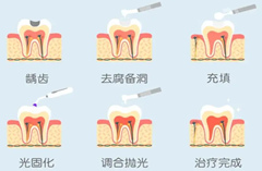 武漢補牙的步驟是怎樣的？