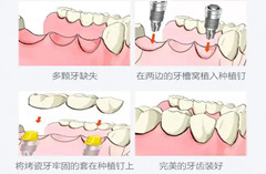 鑲牙的步驟有哪些？