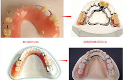 活動義齒的材料有哪些？