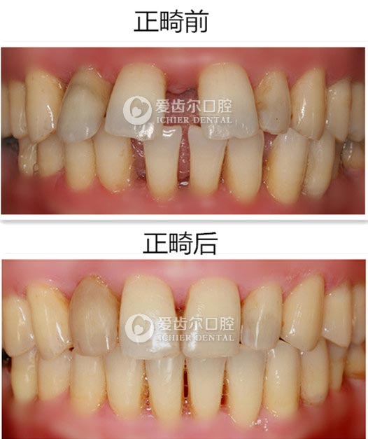 牙列稀疏矯正