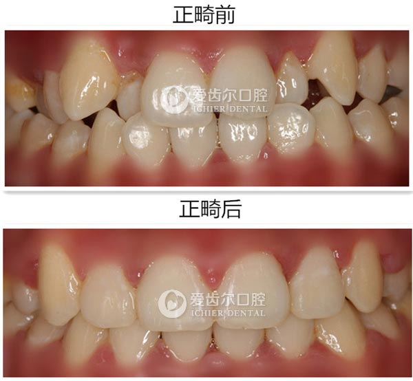 愛齒爾口腔案例對比圖