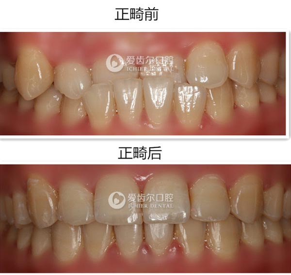 武漢牙齒矯正價格表